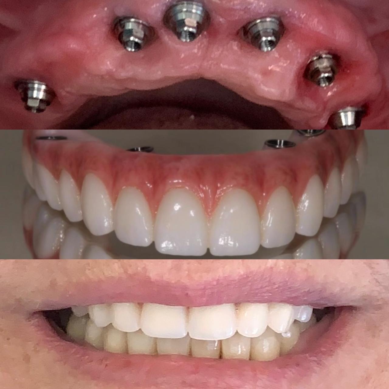 Reabilitação Oral sobre Implantes